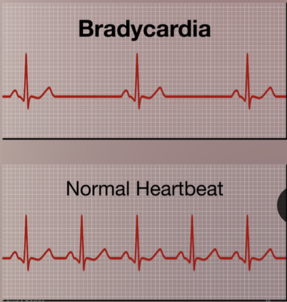 <p>Persistently low heart rate in adults (normal change in athletes).</p><p>Abnormal due to hypothyroidism, electrolyte imbalance, congestive heart failure</p>