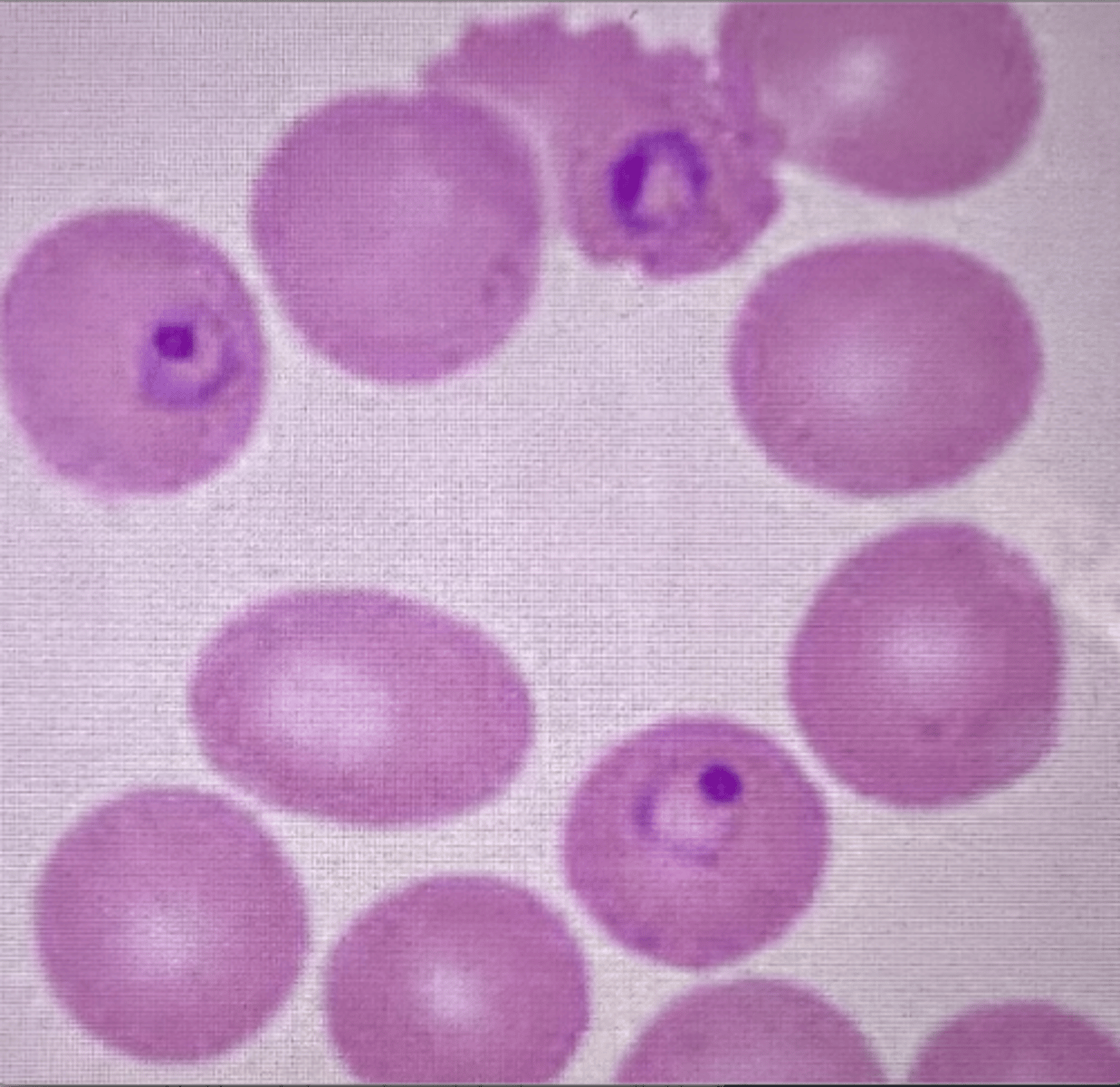 <p>(2) malarial parasite</p><p>ring form: COMPACT RING with HEAVY chromatin dot</p><p>trophozoite: BAND-shaped</p><p>schizont: ROSETTE (DAISY HEAD appearance)</p><p>gametocyte: round or oval</p>