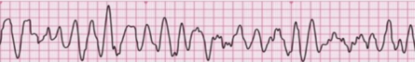 <p>Viðeigandi er að gefa rafstuð sem fyrst</p><p>óreglulegur, hraður taktur með breiðum QRS-komplexum sem er einkennandi fyrir sleglatif (ventricular fibrillation)</p>