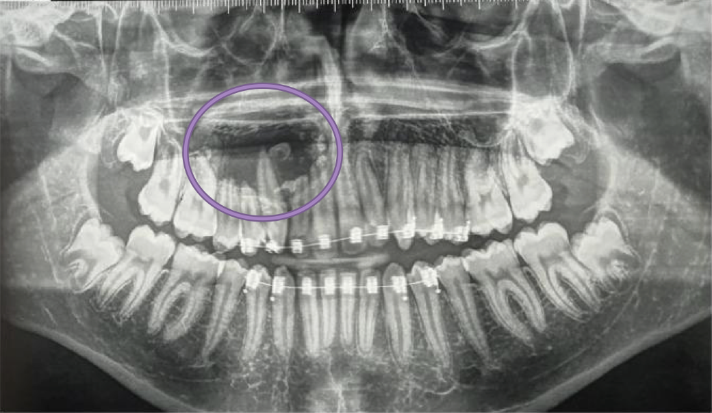 <p>A 17-year-old patient referred by his orthodontist following the fortuitous discovery of a mixed radiolucent/radiopaque image in the right jaw. Provide DD</p>