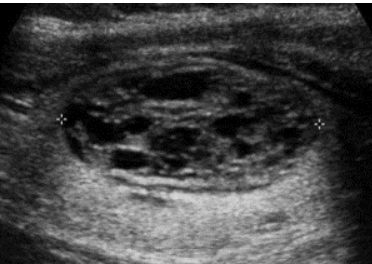 <p><span>What type of composition is this? Does it have a benign or malignant correlation according to TI-RADS</span></p>