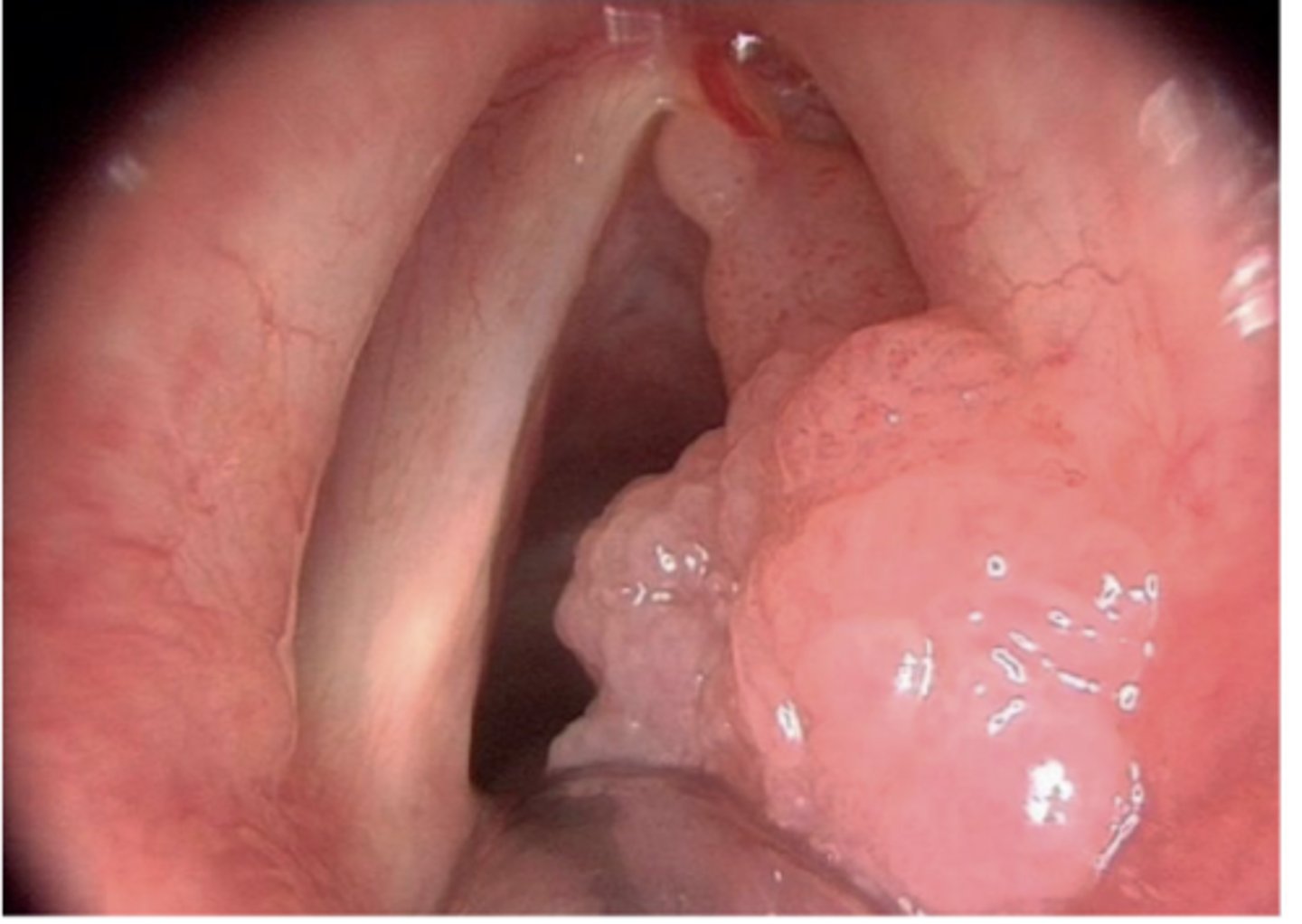 <p>Caused by HPV 6 and 11</p><p>Usually caused by transmission from mother to baby during birth</p><p>Larynx, vocal cords, other areas of respiratory tract</p><p>Recurrent, requires constant surgical removal</p>