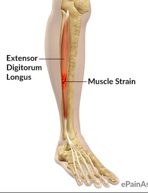 <p><strong>origin:</strong> lateral condyle of tibia</p><p><strong>insertion: </strong>middle and distal phalanges of lateral 4 digits</p><p><strong>innervation:</strong> deep fibular nerve (L4-L5)</p><p><strong>action:</strong> extension of toes and ankle</p>