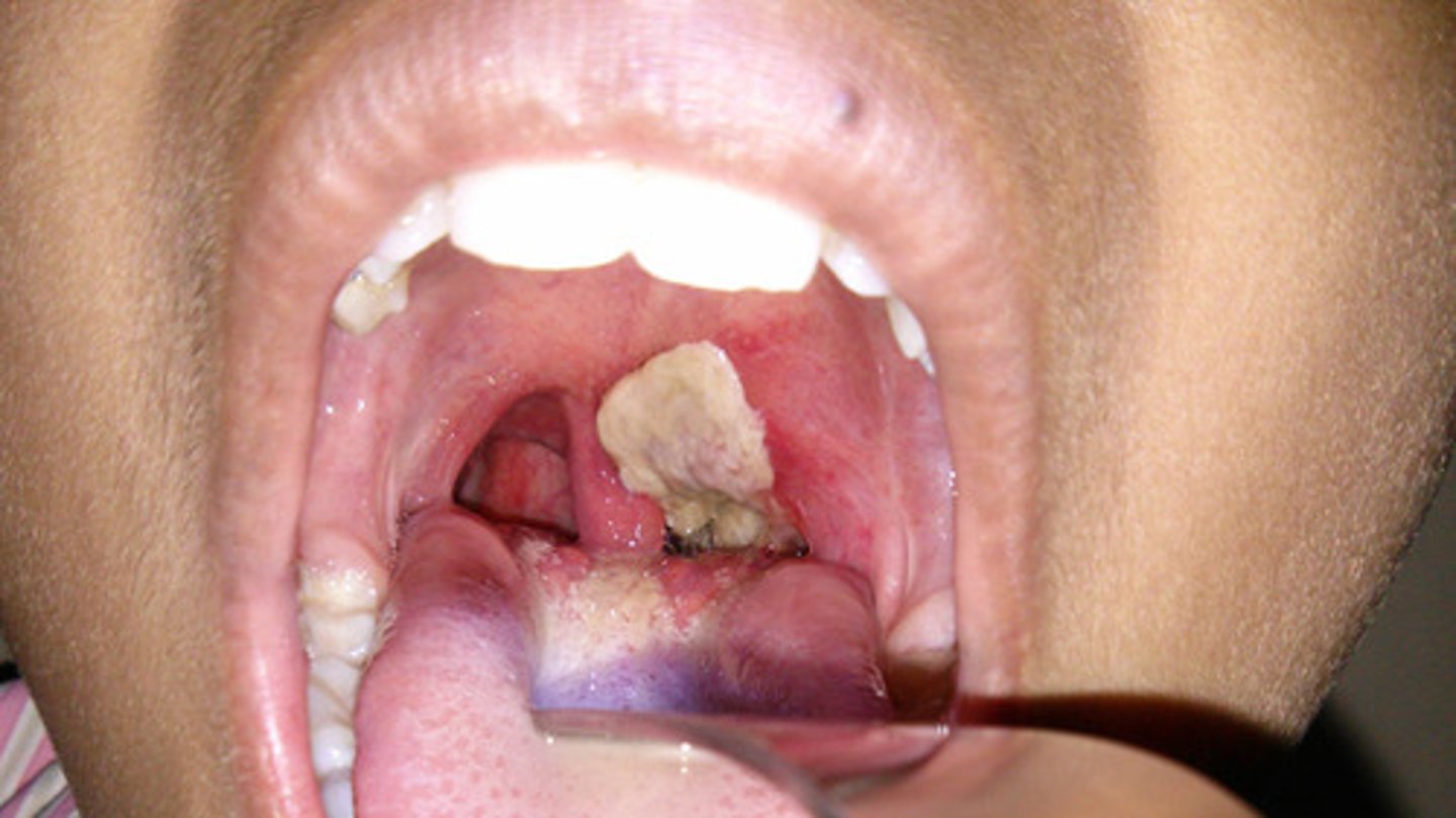 <p>Respiratory issues</p><p>-First symptoms: sore throat, malaise, low-grade fever, dysphagia</p><p>-thick, grey pseudomembrane that can block throat and stop breathing</p><p>-Bull neck: swelling of cervical lymph nodes</p>