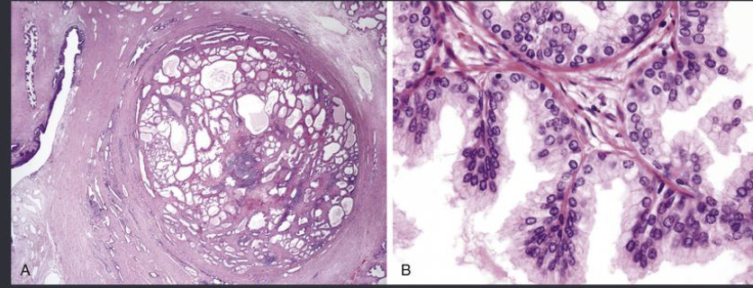 <p>the following histopathology are signs of…?</p><p>• Hyperplastic acini</p><p>• Tightly packed, tall columnar epithelial cells with small basal nuclei</p><p>• Sometimes irregular papillary folds of epithelium</p>