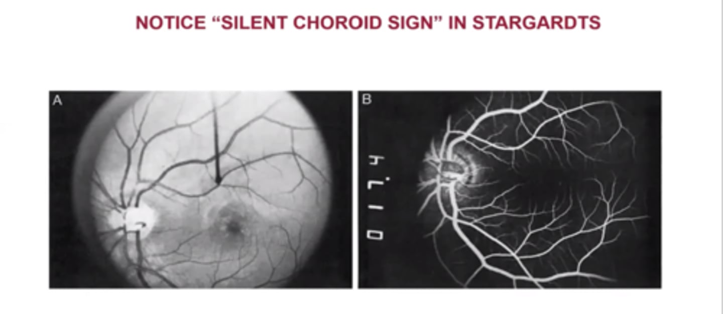 <p>silent choroid sign = dark/silent choroid</p><p>NORMAL: lipofuscin accumulates in RPE = the fundus will hyperF on IVFA (initially choroid is dark)</p>