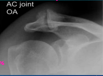 <p><strong>AC Joint Arthritis</strong></p><p>-Chronic _____ at the AC joint. One of the first joints to be affected by arthritis </p><p>-The pt may report pain with movement across the body or up by the head</p><p>-Diagnosis </p><ul><li><p>X-ray evidence of __________ → joint space narrowing and osteophytes </p></li></ul><p>-Treatment</p><ul><li><p>________, injections, and surgical ________ if conservative treatment failed </p></li></ul><p></p>