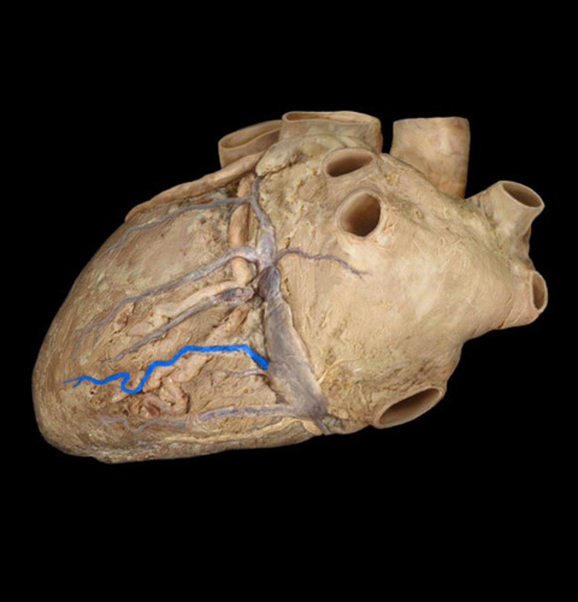<p>posterior interventricular sulcus</p><p>middle string coming out of sinus</p>