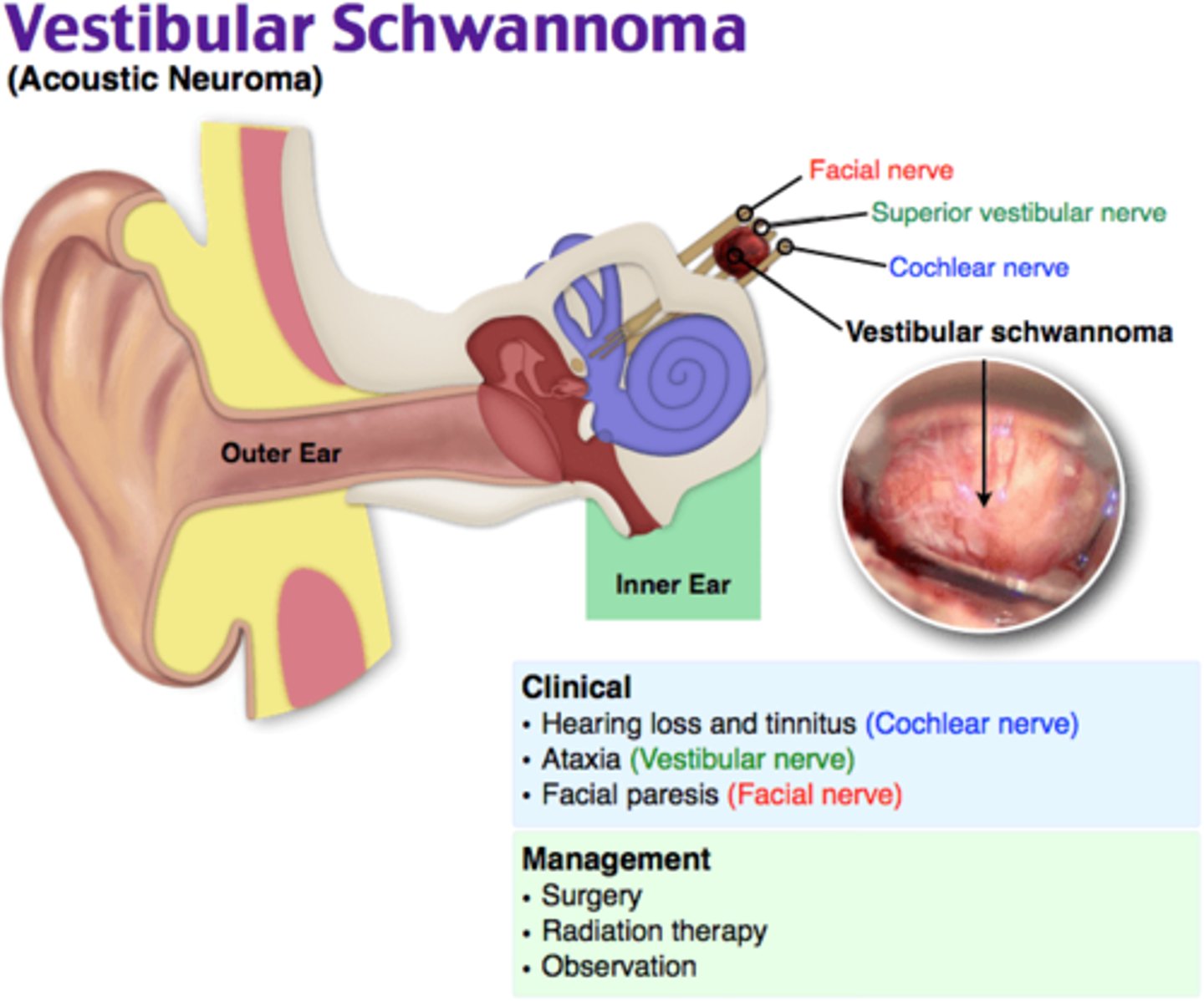 <p>Acoustic neuroma</p>