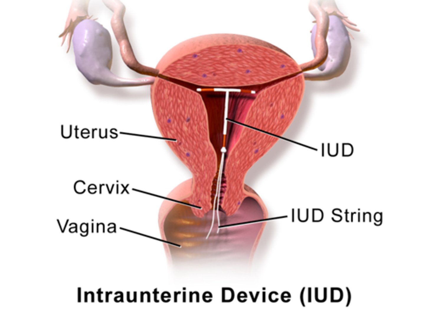 <p>A contraceptive method that is a small piece of plastic and is inserted into the uterus. Blocks fallopian tubes. 99% effective. Remains inserted 3-5 years.</p>