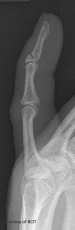 <p>A dorsal intra-articular avulsion fracture of the distal phalanx, caused by forcible flexion of an extended finger (e.g., ball hitting fingertip).</p>