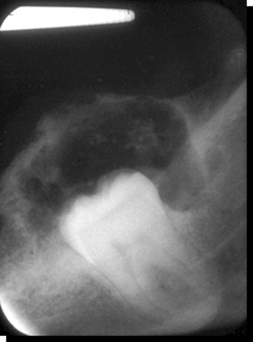 <p>36 y/o patient presents with well circumscribed, corticated unilocular lesion on the posterior mandible that surrounds the crown of tooth #30, with mixed radiopacities around the crown of the tooth. Lesion is expansile and root resorption possible. What is the diagnosis?</p>