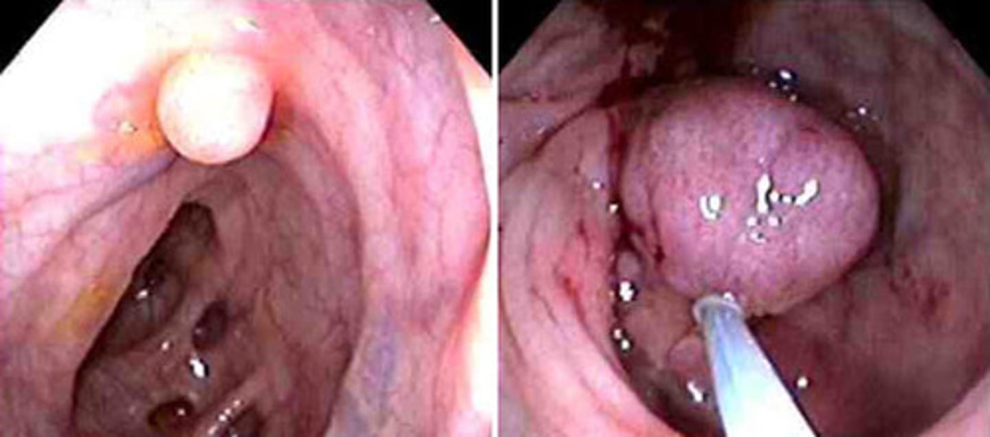 <p>Most carcinomas of the colon are believed to arise in these preexisting lesions</p>