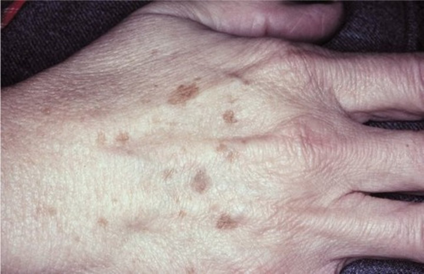 <p>actinic lentigo</p>