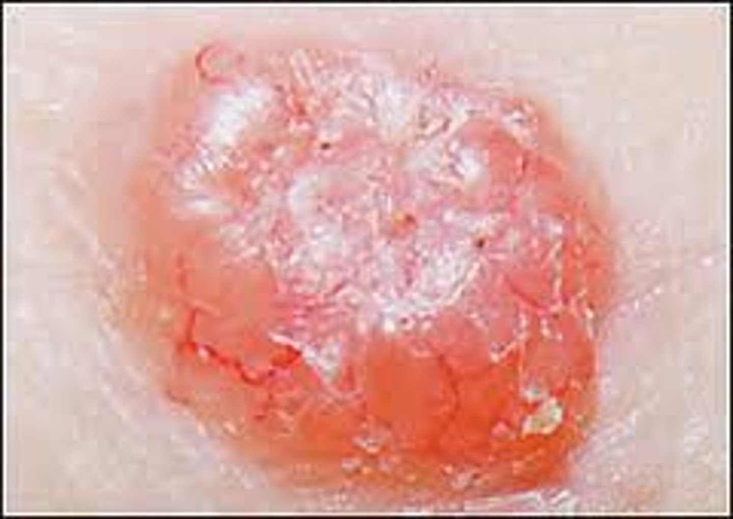 <p>center of lesion depressed compared to edge (basal cell carcinoma)</p>