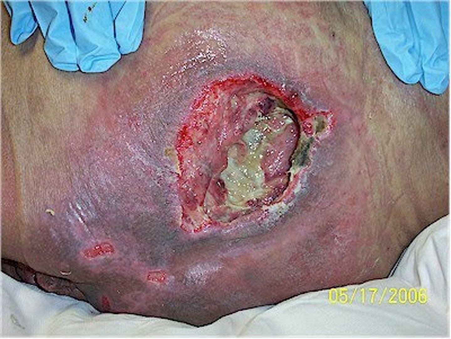 <p>Pressure Injuries: Stage</p>