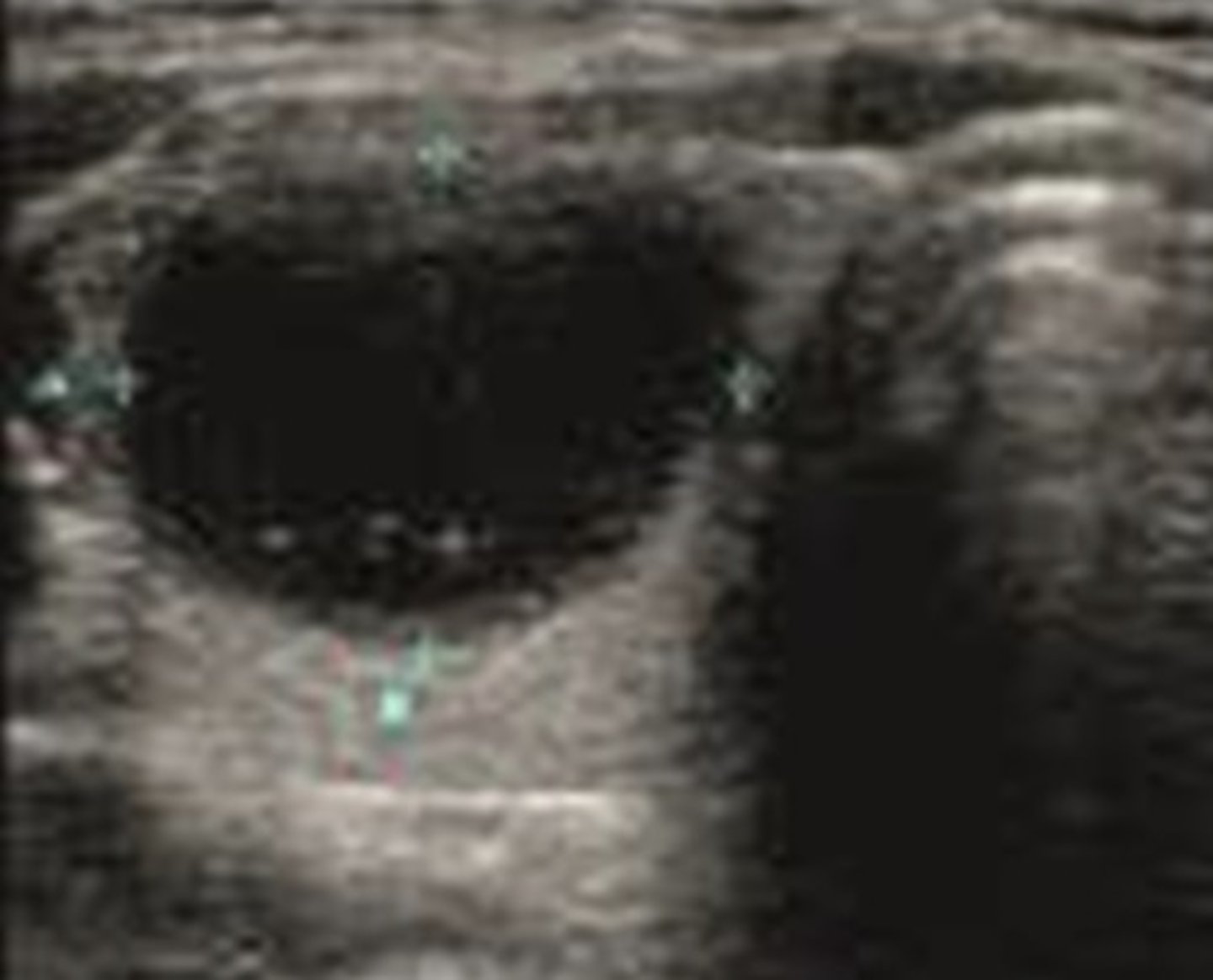 <p>Simple, complex, or hemorrhagic</p><p>*Posterior Enhancement</p>