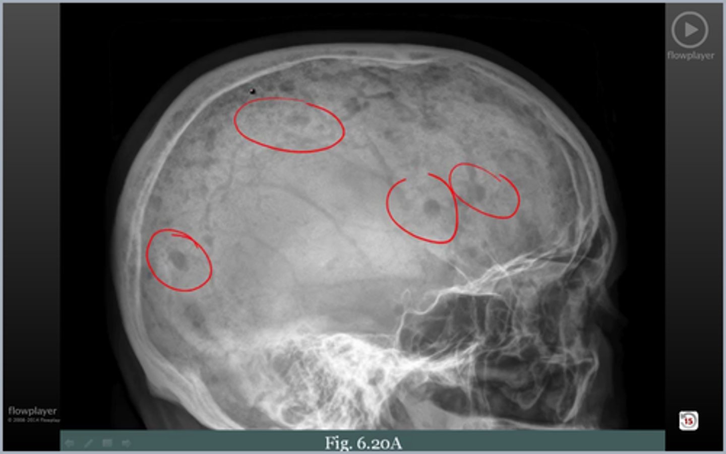 <p>punched out lesions on x-ray</p>