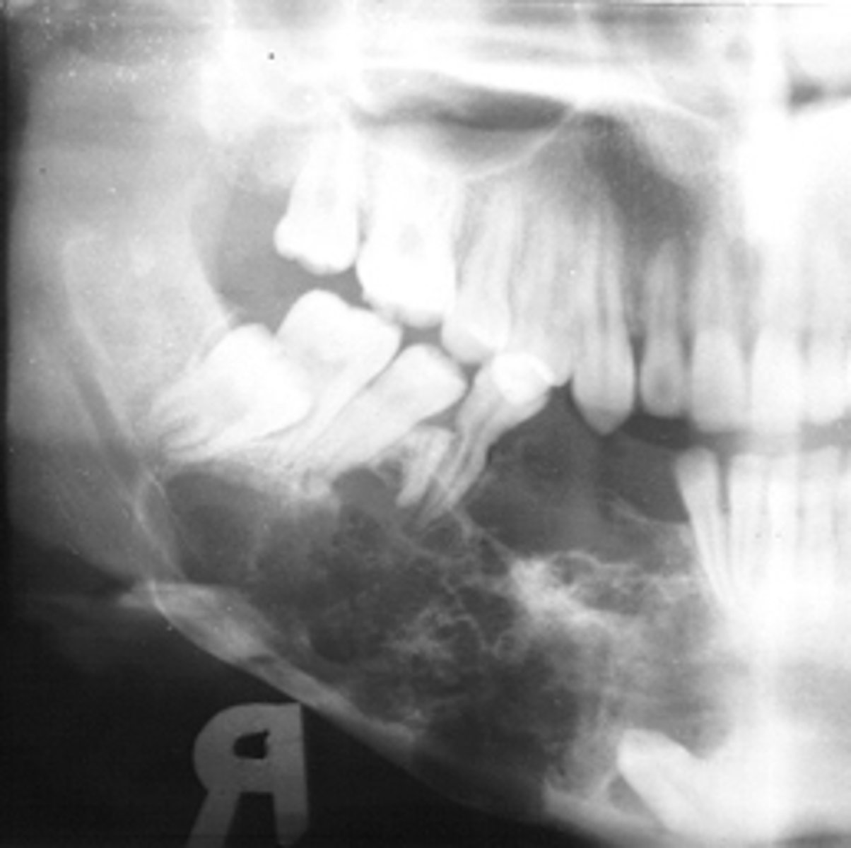 <p>40 y/o patient presents with a well defined, corticated, multi-locular with thick/coarse curved septae lesion on the posterior mandible. Thinning and expansion of the border of the mandible is evident and it displaces the IAN inferiorly. The roots of the surrounding teeth are displaced. The lesion is VERY expansile. What is the diagnosis?</p>