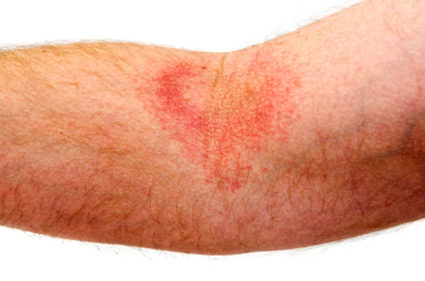 <p>commonly occurs on face, hands, feet, flexor surfaces of elbows/knees</p>