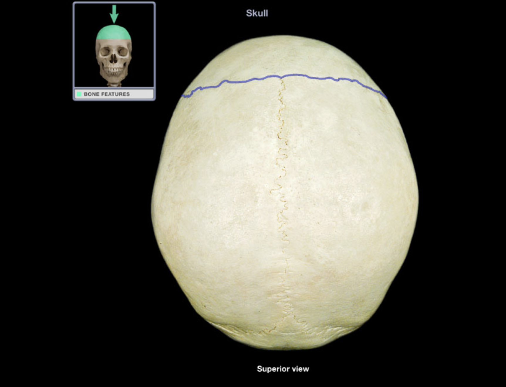 <p>Coronal suture</p>