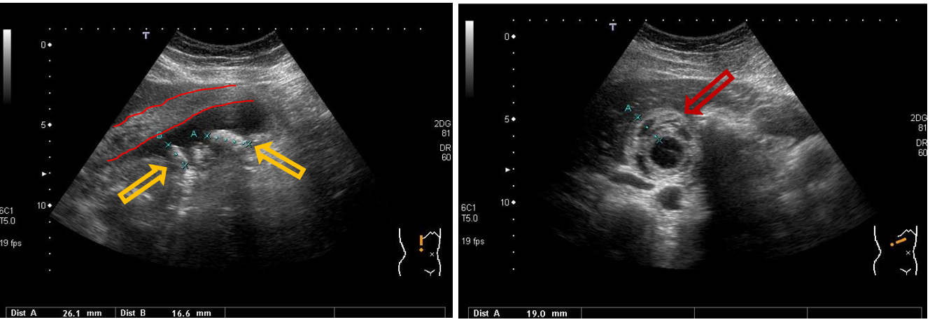 <p>Patient history: fever, nausea, strong right upper abdominal pain Modality: B-mode gallbladder ultrasonography, convex probe (3.5–5 MHz)</p><p>Region: gallbladder, right subcostal view, longitudinal (left) and transverse (right) planes </p><p>Radiologic sign: echodense structure in the gallbladder lumen (yellow arrow) with acoustic shadowing; thick, stratified, oedematous wall (red arrow and red lines) </p><p>Diagnosis: cholecystitis with gallstone</p>