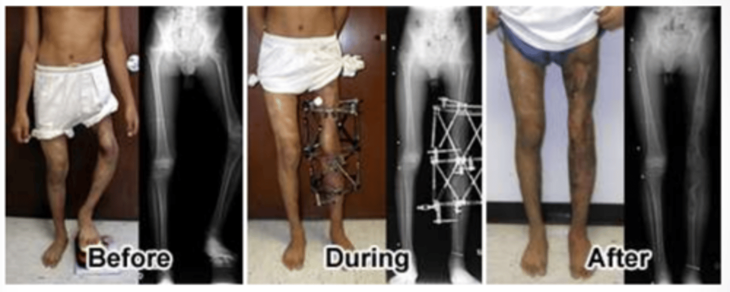 <p>Provides alignment forces to fracture fragments and maintains reduction while healing.</p>