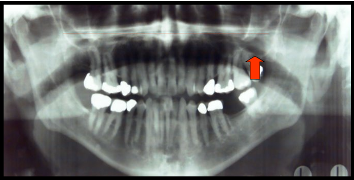 <ul><li><p><span>One appears as a horizontal radiopaque band superior to the apices of maxillary teeth.</span></p></li><li><p><span>One appears as paired radiolucent areas located superior to the apices of maxillary premolars and molars.</span></p></li></ul><p></p>