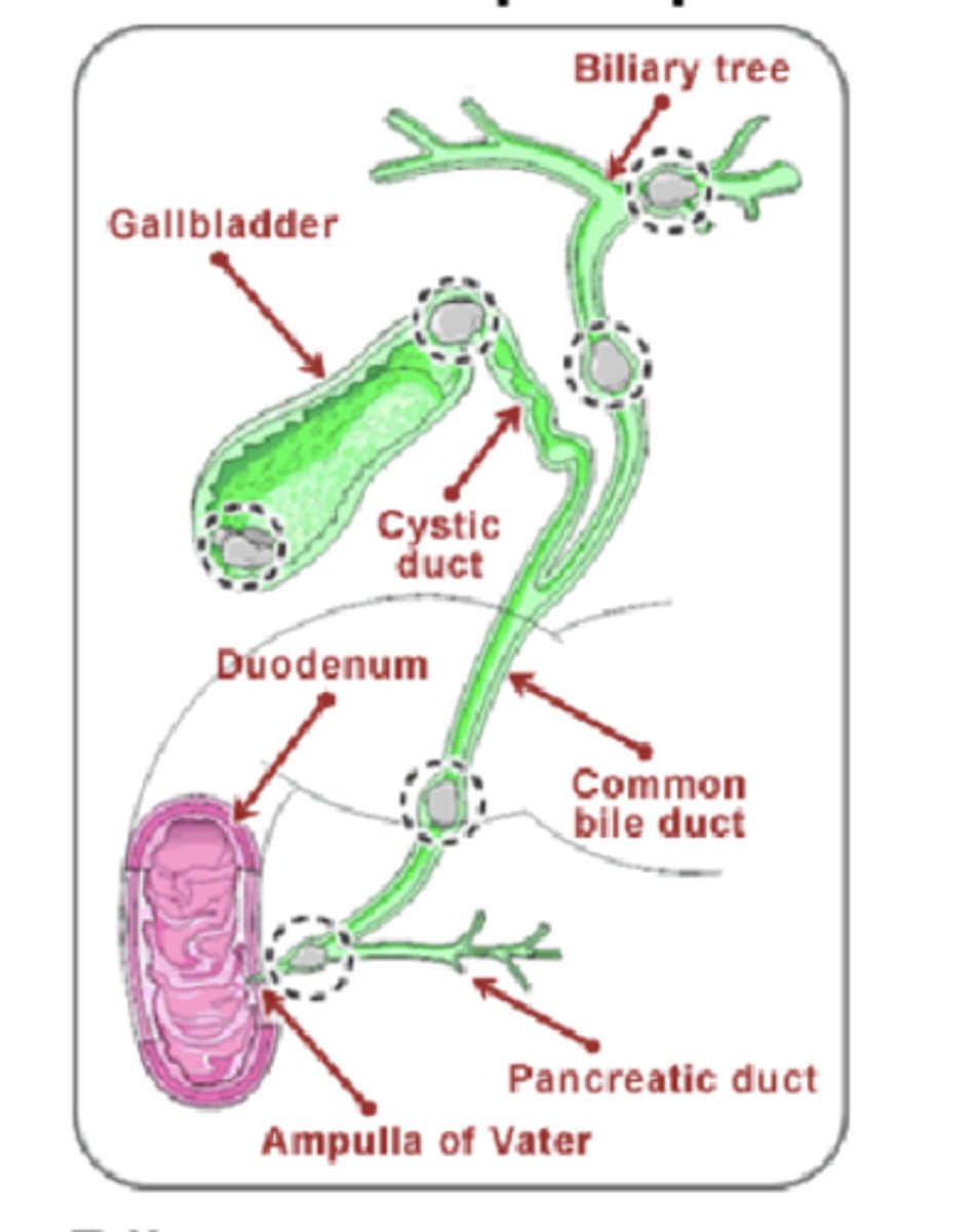 <p>-pancreatitis (majority)--&gt; due to blockage pancreatic duct; painful inflammation of pancreas</p><p>-inflammation of gallbladder</p><p>-blockage of biliary flow anywhere in biliary tree if large enough</p>