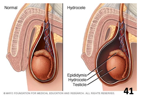 <ul><li><p><strong>Collection of peritoneal fluid between layers of the tunica vaginalis</strong></p><ul><li><p class="p2">More common in men >40 years of age</p></li></ul></li></ul><p></p>