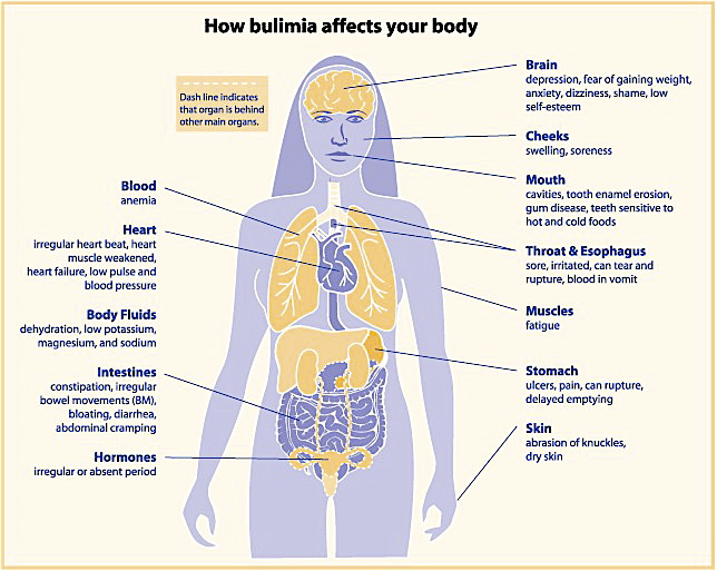 <ol><li><p><span><span>The first goal is to address the binging and decrease the amount of food consumed in a sitting.</span></span></p></li><li><p><span><span>Allow healing of the esophagus and decrease damage to the teeth&nbsp;</span></span></p></li><li><p><span><span>Cognitive behavior theraphy to improve self esteem &amp; learn to cope with stressful situations.&nbsp;</span></span></p></li></ol><p></p>