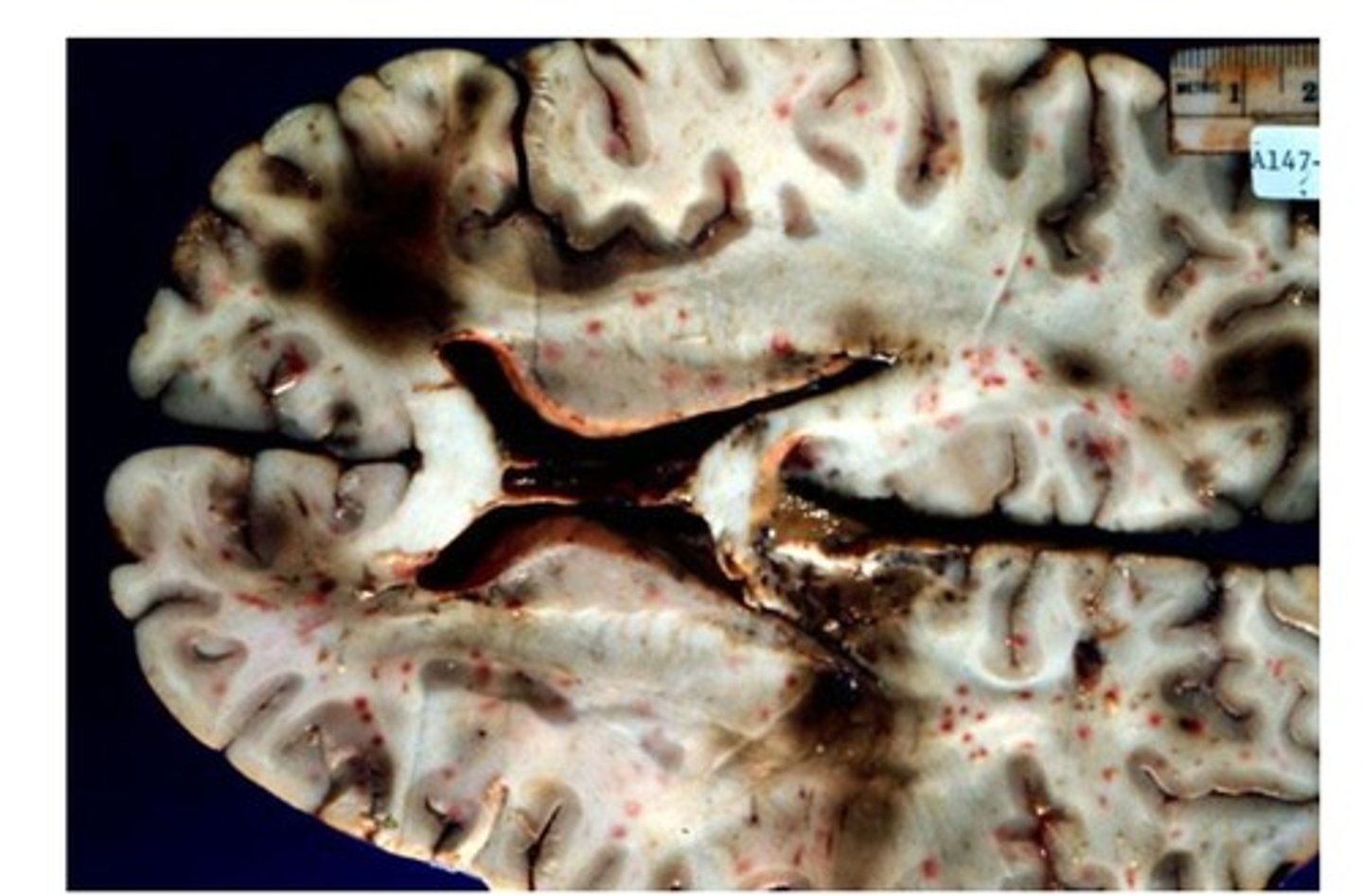 <p>Define Fat Embolus</p>