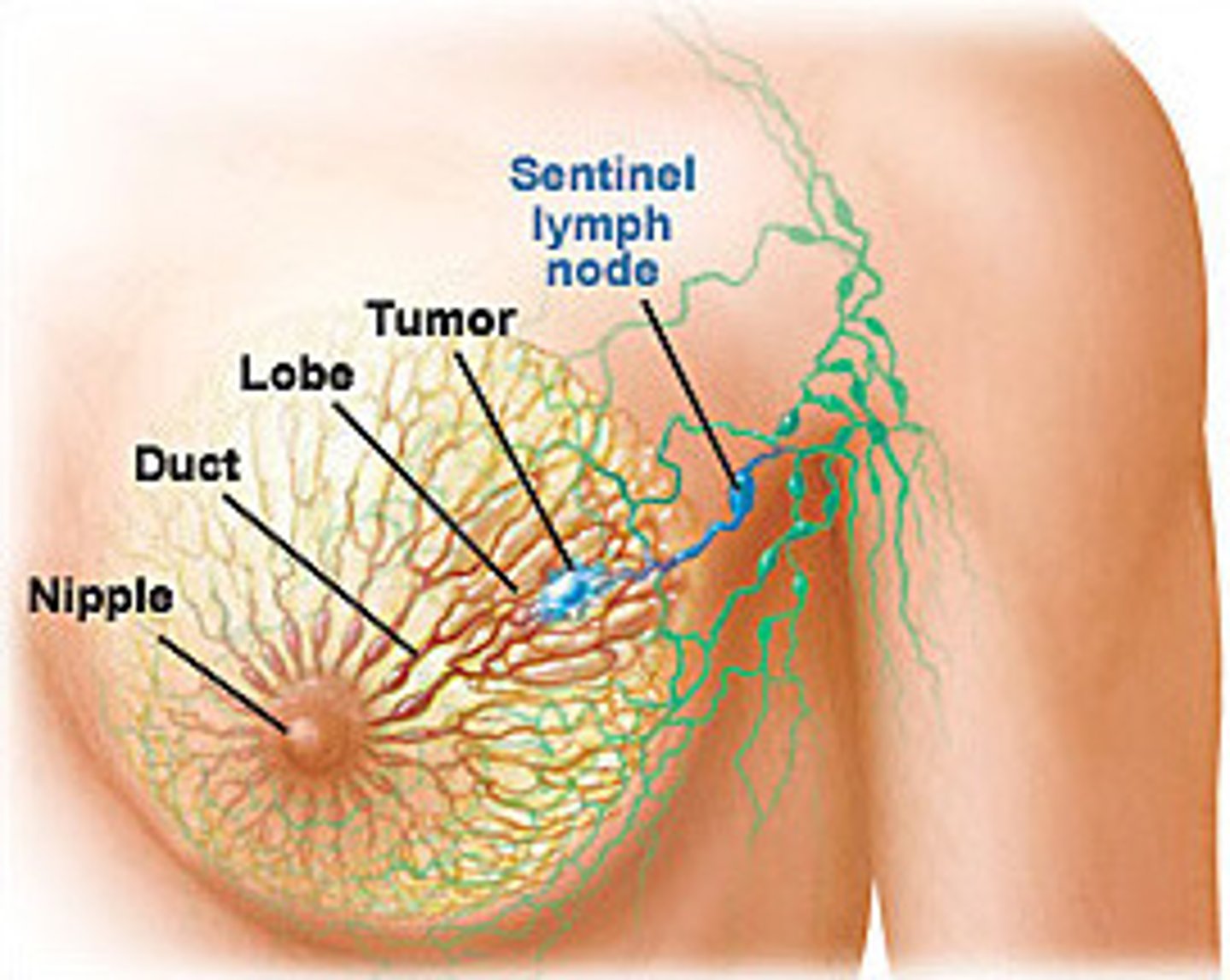 <p>where the cancer cells are likely to reach first<br>in the pathway of the primary tumor</p>