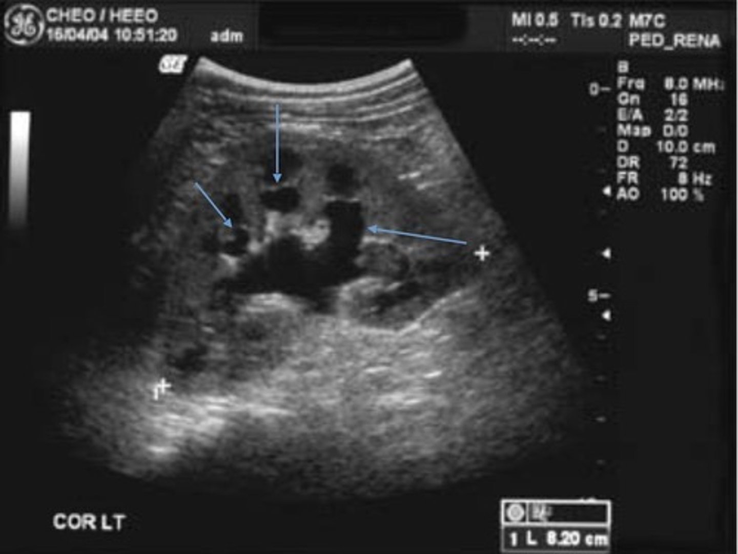 <p>Pelvis is > 10 mm</p><p>Marked dilation of calyces</p><p>Cortex is normal</p>