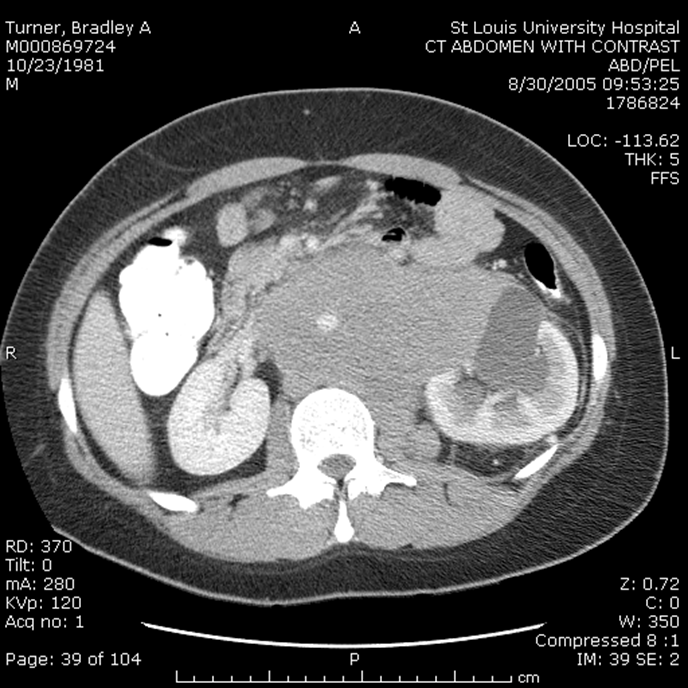 <p>What type of cancer does he have?</p><p>LD 953 (80-210)</p><p>Beta HCG 11.1 (less than 1)</p><p>AFP 1.1 (less than 15)</p><p><u>Choriocarcinoma</u></p>