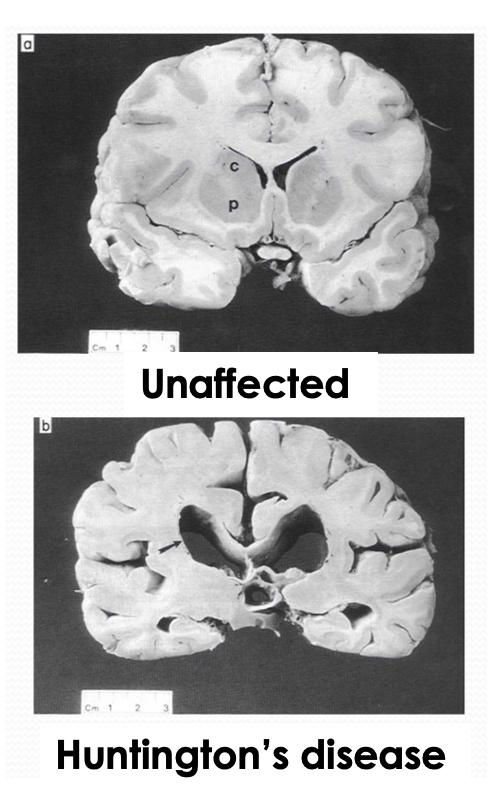 <p>Describe Huntington’s disease </p>
