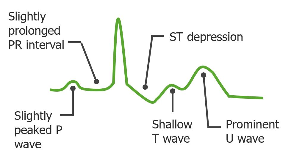 <p>a) U waves</p><p>c) inverted T waves</p><p>d) depressed ST segment</p>
