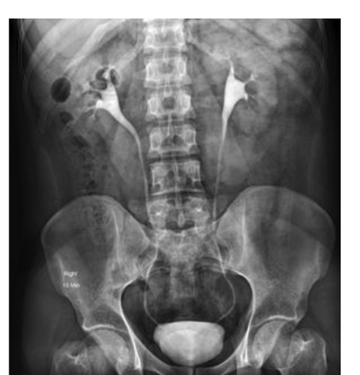 <p>Functional exam to visualize the collecting portion of the urinary system, and assess the function of the kidneys, bladder and ureters.</p><p>Clinical indications: back pain, kidney stones, kidney dysfunction, hematuria, abdominal/pelvic mass, UTI, hypertension</p>