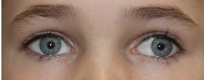 <p>a condition in which the eyes do not properly align with each other when looking at an object. </p>