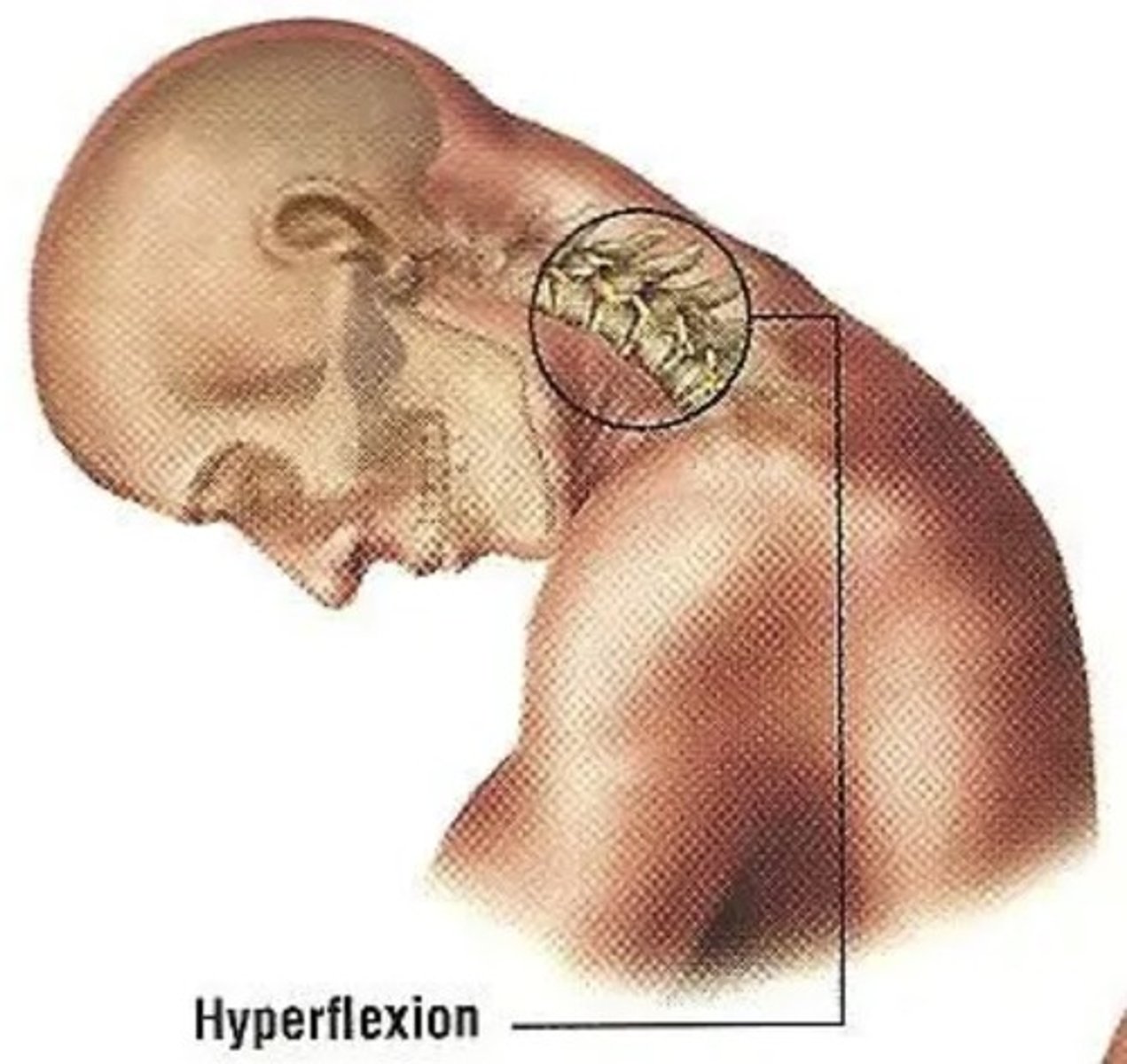 <p>Head violently moves backward and quickly hyperflexes forwards</p>