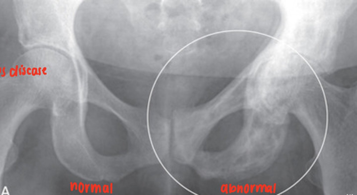 <p>focal disorder of bone metabolism, accelerated bone remodeling resulting in overgrowth, impairs integrity of affected bone, X-Ray and radionuclide bone scan</p>