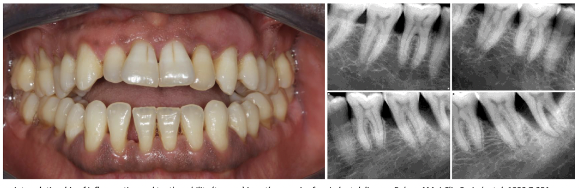 <ul><li><p>Occlusal trauma (bruxism, premature occlusal contact, crossbite, attrition, wear facets) alone <strong>do not cause periodontitis.</strong></p></li><li><p>When combined with periodontal inflammation, occlusal trauma may accelerate attachment loss and development of vertical bone loss</p></li></ul><p></p>