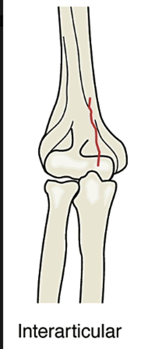 <p>fracture involves bones within a joint</p>