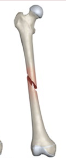 <p>What fracture is this?</p>