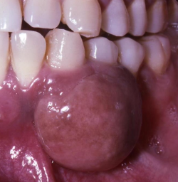<p>Primarily involve the craniofacial skeleton such as paranasal sinuses</p>