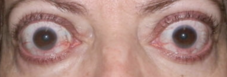<p>Abnormal findings of <strong><em>2. Inspect Eyelids &amp; Eyelashes</em></strong></p><ul><li><p>Retracted lid margins</p></li><li><p>Viewing of sclera when eyes are open</p></li><li><p>Suggest hyperthyroidism</p></li></ul><p></p>