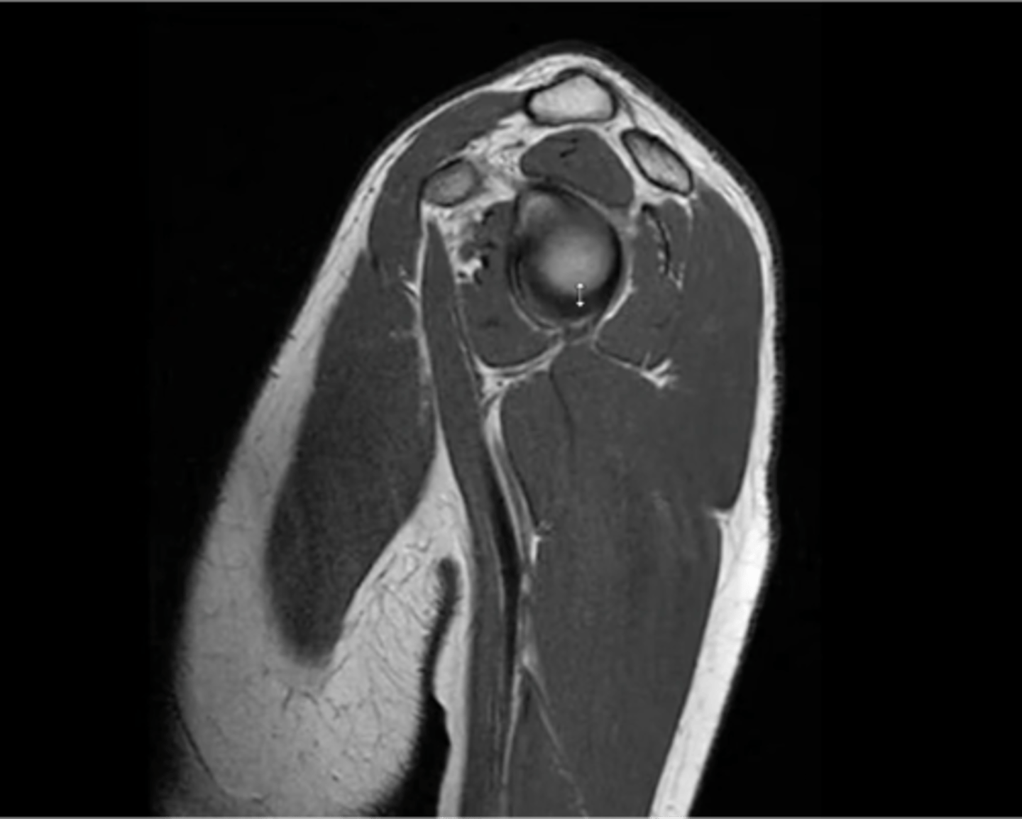 <p>Which structures are present in this image as we work our way inwards towards the glenoid fossa and labrum?</p>