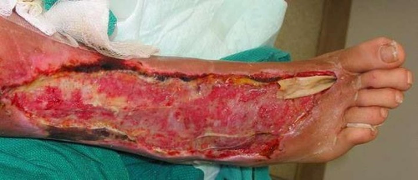 <p>A condition caused by Clostridium perfringens where endospores germinate and produce toxins leading to necrosis</p>