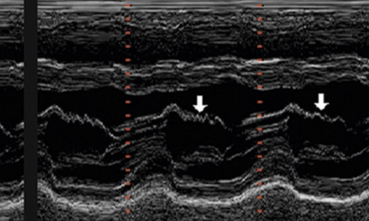 <p>aortic insufficiency</p>