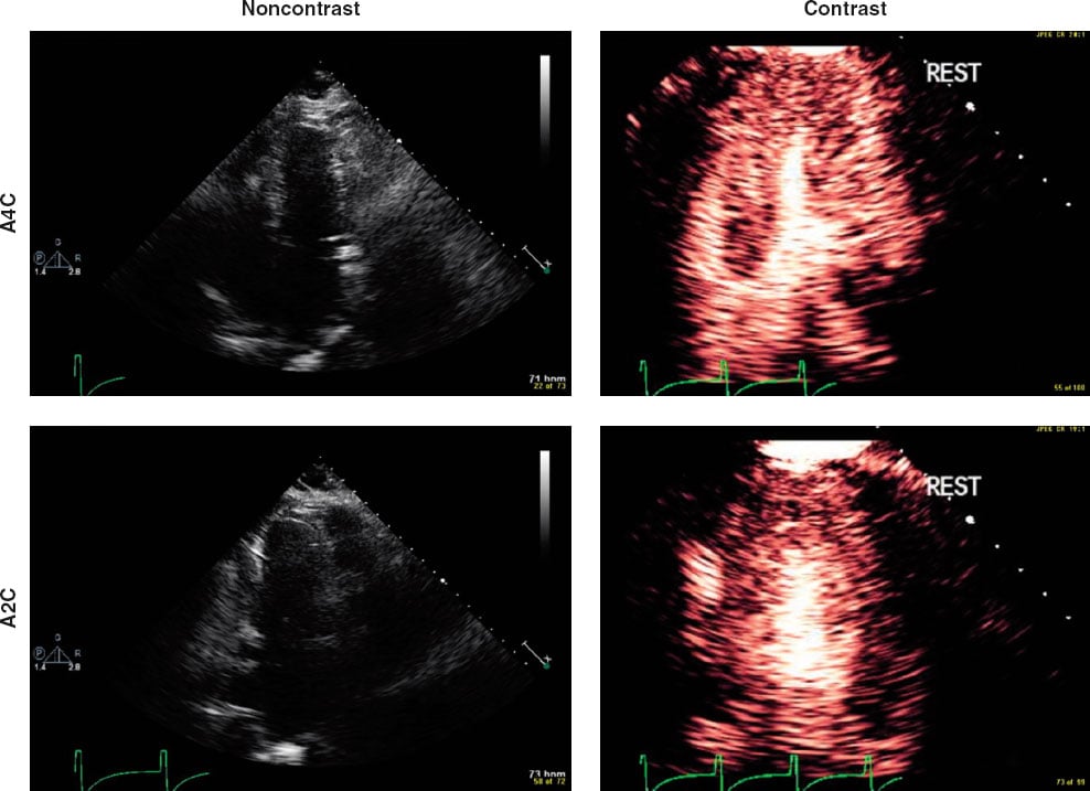 <p>Diffuse T-wave inversions on ECG and the following end systolic images. What does this show?</p>
